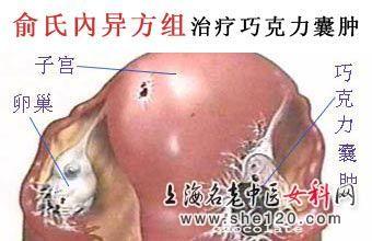 巧克力囊肿的治疗费用多少？
